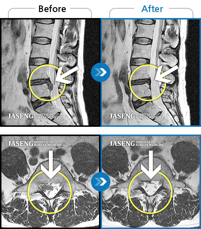 자생한방병원 치료사례 MRI로 보는 치료결과-오른 다리 통증, 야간통