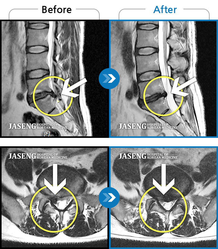 자생한방병원 치료사례 MRI로 보는 치료결과-일어서질 못할 정도의 다리 통증
