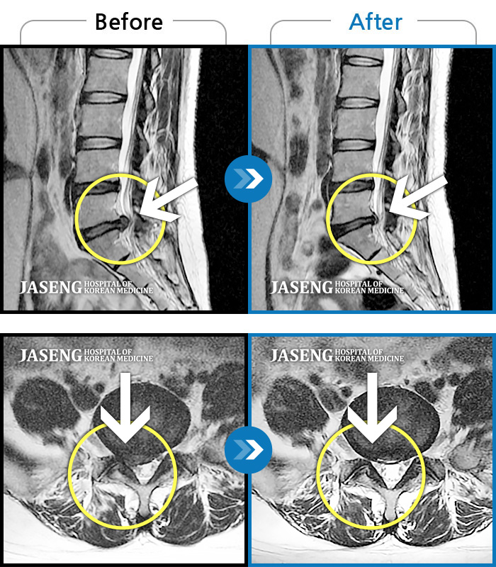 자생한방병원 치료사례 MRI로 보는 치료결과-엉치 통증 및 우측 종아리 후면 통증
