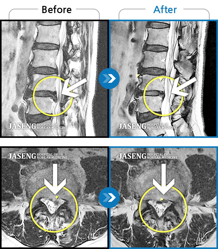 자생한방병원 치료사례 MRI로 보는 치료결과-좌측 엉덩이 통증과 함께 좌측 종아리 통증