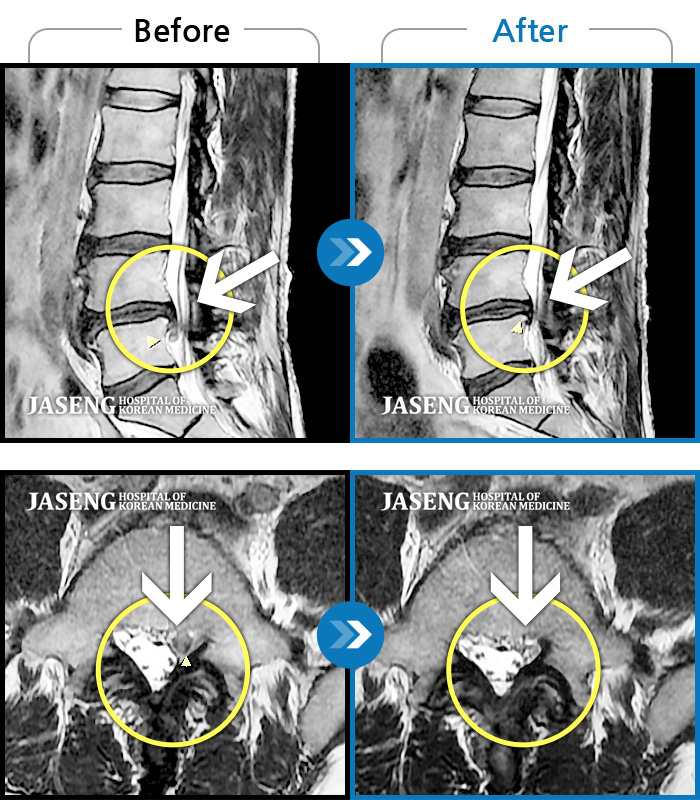 자생한방병원 치료사례 MRI로 보는 치료결과-허리 및 좌측 엉덩이 통증, 좌측 하지 통증과 함께 근력 악화