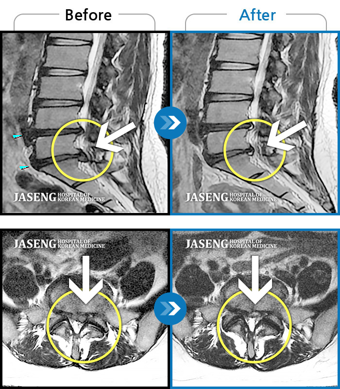 자생한방병원 치료사례 MRI로 보는 치료결과-허리 통증과 좌측 엉치, 하지에 저림