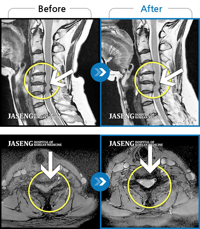 자생한방병원 치료사례 MRI로 보는 치료결과-목디스크로 후경부 좌측 통증, 좌측 손가락 저림