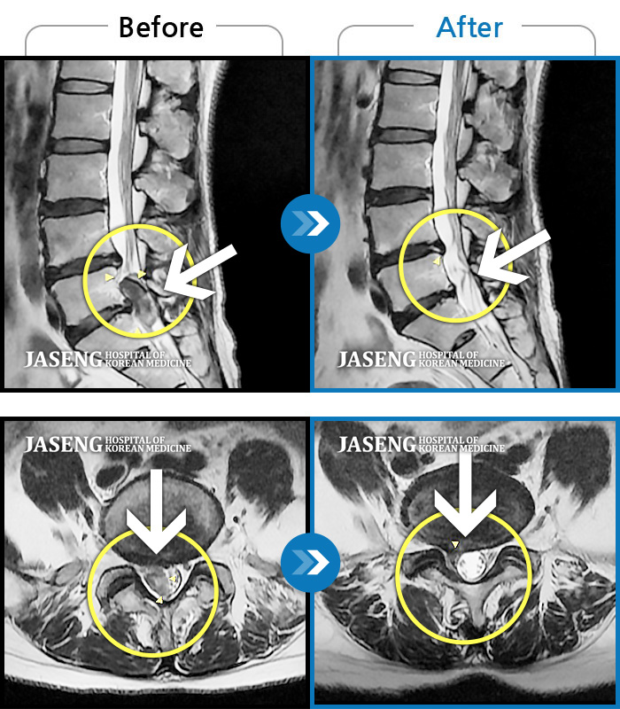 자생한방병원 치료사례 MRI로 보는 치료결과-허리통증 및 우측 하지 저림과 근력 저하