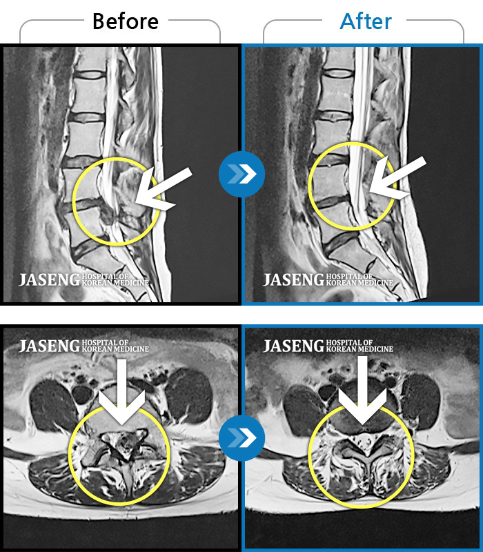 자생한방병원 치료사례 MRI로 보는 치료결과-왼쪽 꼬리뼈, 엉덩이, 다리 통증