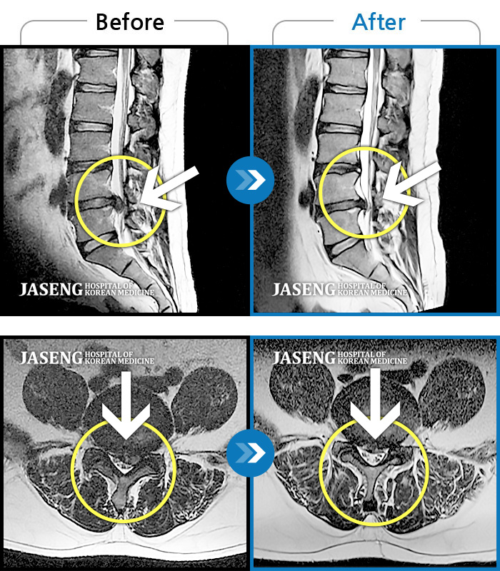 자생한방병원 치료사례 MRI로 보는 치료결과-허리통증 및 하지 방사통