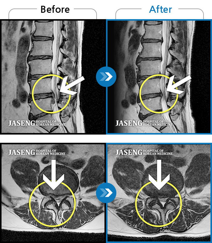 자생한방병원 치료사례 MRI로 보는 치료결과-요부 및 우하지 극통으로 거동이 불가