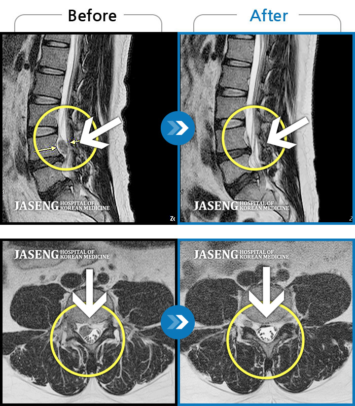 자생한방병원 치료사례 MRI로 보는 치료결과-허리디스크로 인한 양측 허리 통증