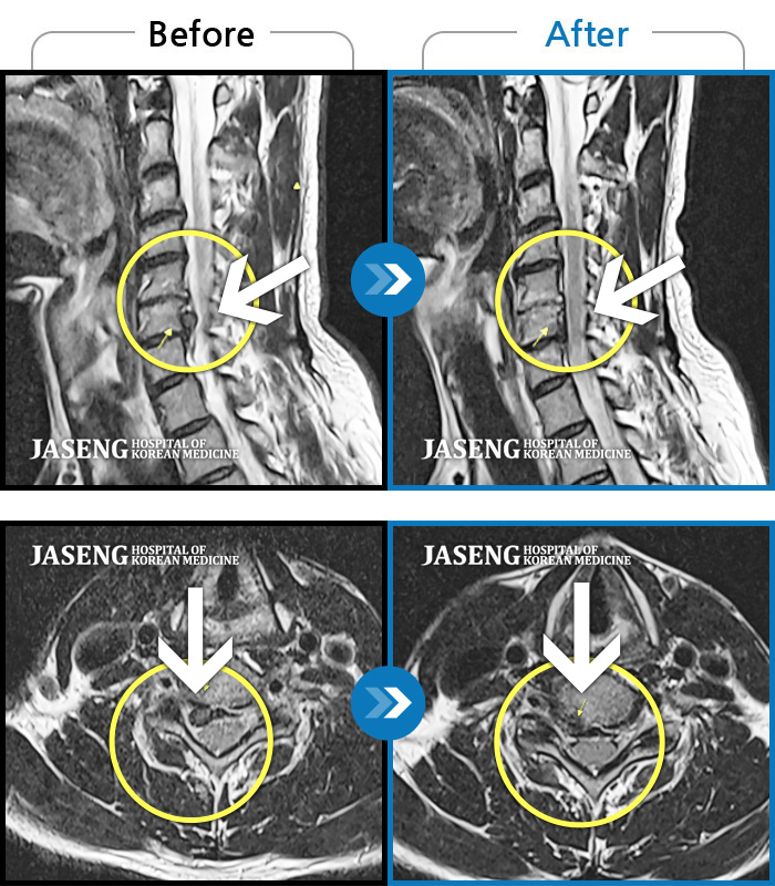 자생한방병원 치료사례 MRI로 보는 치료결과-목디스크로 인한 목통증 및 간헐적 손바닥 저림 증상