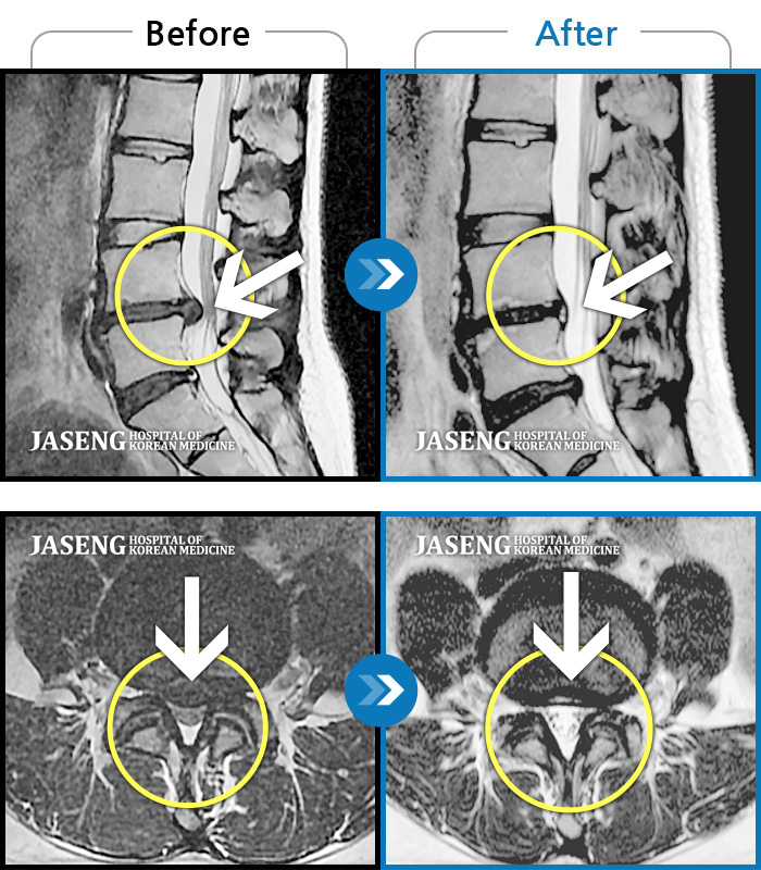 자생한방병원 치료사례 MRI로 보는 치료결과-허리통증, 오른쪽 다리 저림 및 통증