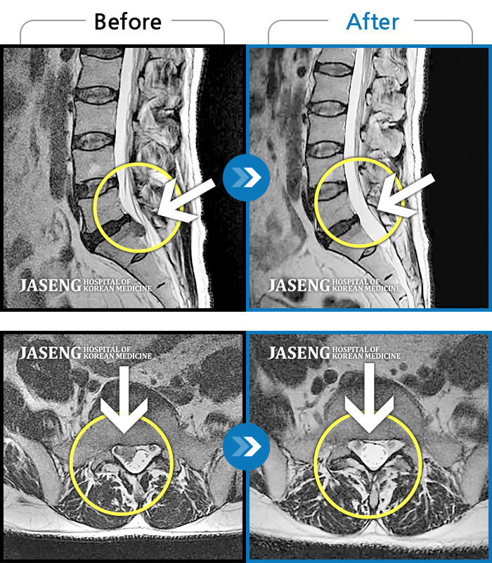 자생한방병원 치료사례 MRI로 보는 치료결과-오래 앉아 있으면 오른쪽 아래 허리 통증 심화