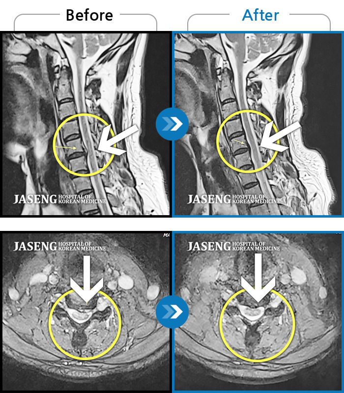 자생한방병원 치료사례 MRI로 보는 치료결과-목 양쪽 통증, 후두통에 두통
