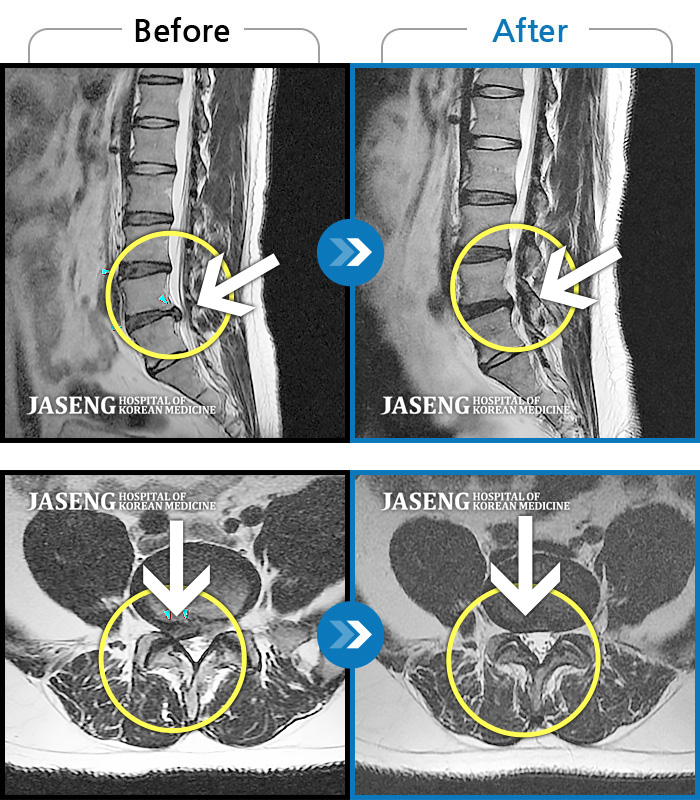 자생한방병원 치료사례 MRI로 보는 치료결과-우측 엉치에서 발끝까지 저림