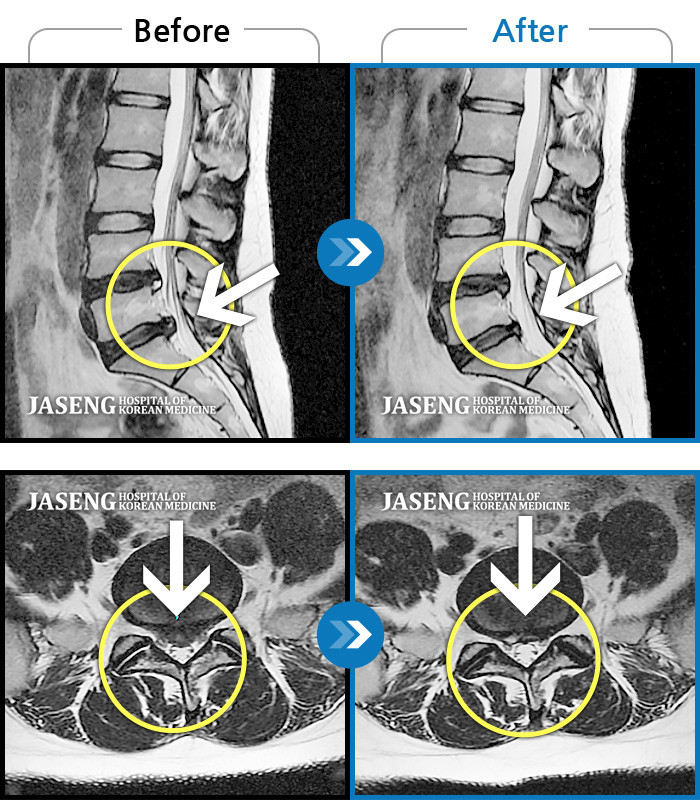 자생한방병원 치료사례 MRI로 보는 치료결과-허리와 우측 골반 통증