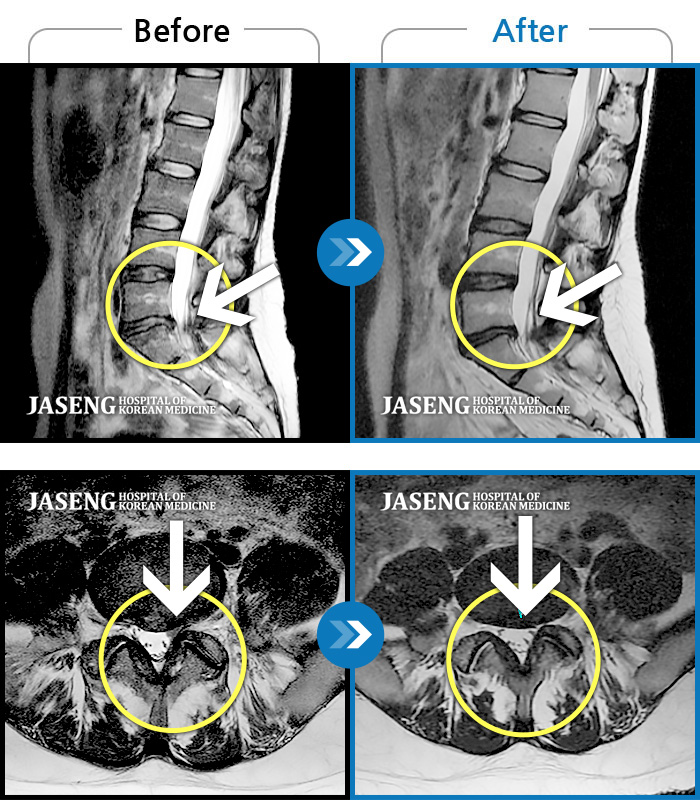 자생한방병원 치료사례 MRI로 보는 치료결과-허리 통증, 똑바로 서려고 하거나 걸을 때 양쪽 허벅지와 고관절 시큰거림