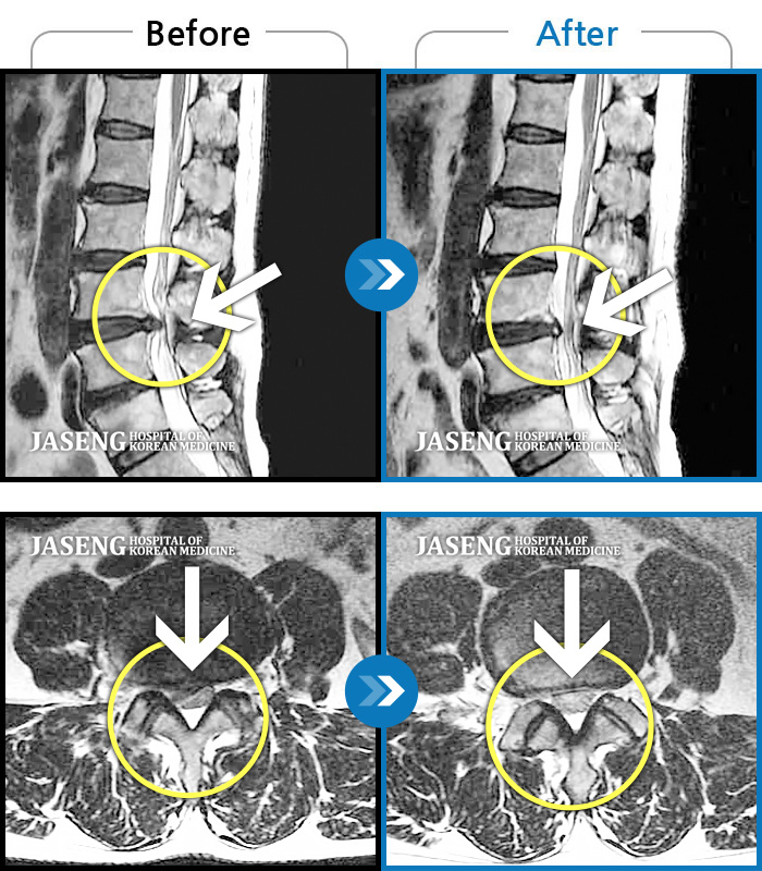 자생한방병원 치료사례 MRI로 보는 치료결과-허리통증, 오른쪽 둔부와 다리에 당김 증세 및 통증