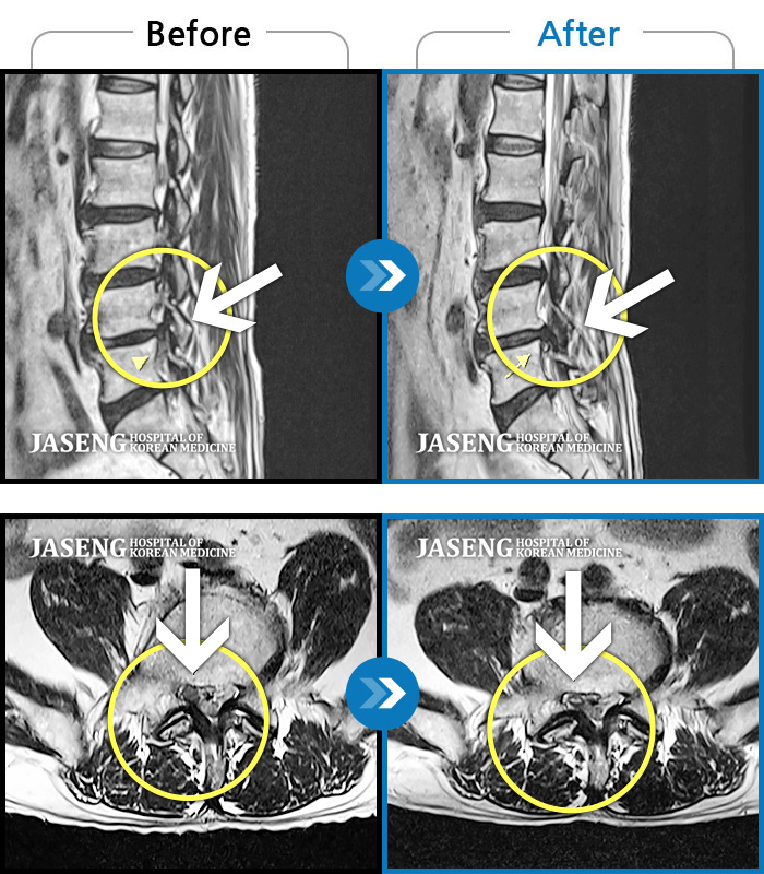 자생한방병원 치료사례 MRI로 보는 치료결과-허리 우측 골반에서 발목으로 통증