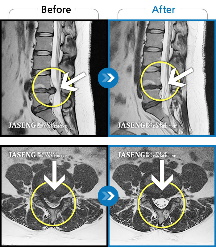 자생한방병원 치료사례 MRI로 보는 치료결과-요추 4,5번 급성 허리디스크