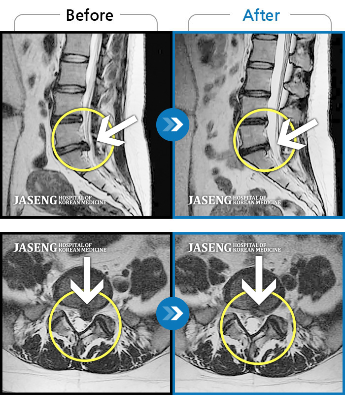 자생한방병원 치료사례 MRI로 보는 치료결과-허리 통증과 좌측 다리 통증