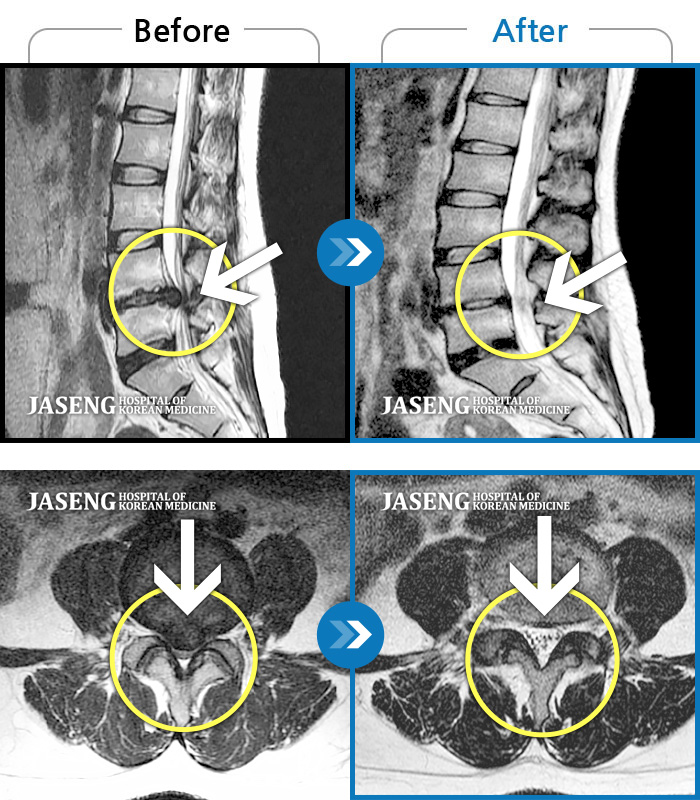 자생한방병원 치료사례 MRI로 보는 치료결과-허리디스크로 내원