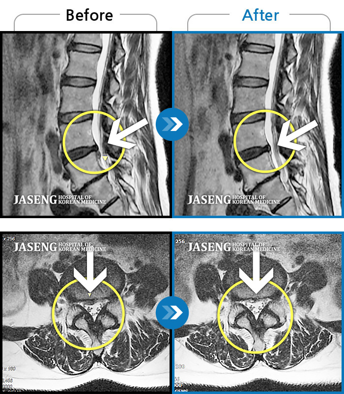 자생한방병원 치료사례 MRI로 보는 치료결과-허리디스크로 연골이 거의 없다고 진단 받음
