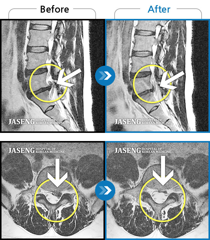 자생한방병원 치료사례 MRI로 보는 치료결과-허리와 좌측 골반 통증, 좌측 다리에 통증 및 근력, 감각 저하