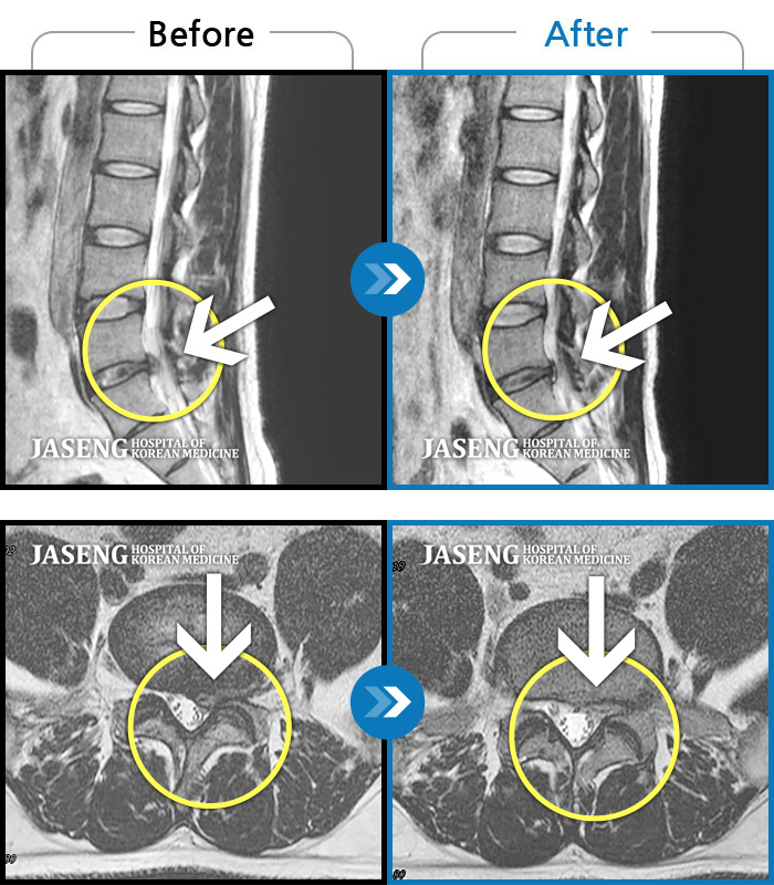 자생한방병원 치료사례 MRI로 보는 치료결과-허리통증과 왼쪽 하지 저림