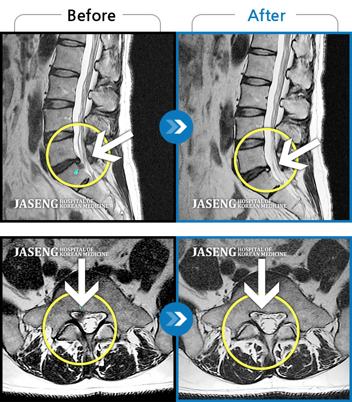 자생한방병원 치료사례 MRI로 보는 치료결과-우측 다리가 저리고 감각이 둔함