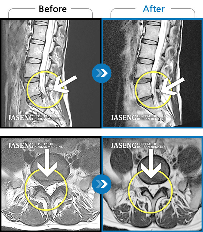 자생한방병원 치료사례 MRI로 보는 치료결과-장시간 앉았다가 서면 허리 펴기 힘들고 오른쪽 종아리가 당김