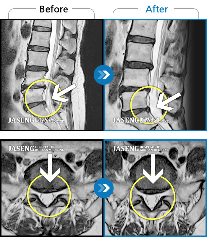 자생한방병원 치료사례 MRI로 보는 치료결과-좌측 하지 및 골반 방사통 및 저림증상