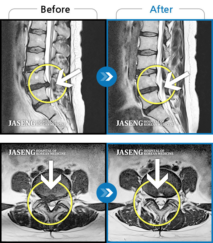 자생한방병원 치료사례 MRI로 보는 치료결과-허리와 우측골반, 우측다리 통증