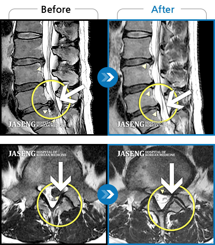 자생한방병원 치료사례 MRI로 보는 치료결과-하부요추와 좌측 하지 후면 통증, 좌측하지 감각저하, 근력저하