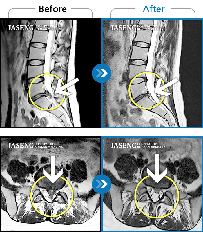 자생한방병원 치료사례 MRI로 보는 치료결과-요추 5번과 천추 1번 사이에서 탈출된 디스크가 신경막을 압박