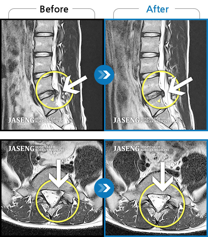자생한방병원 치료사례 MRI로 보는 치료결과-좌측 허리부터 골반까지 통증, 골반이 틀어짐