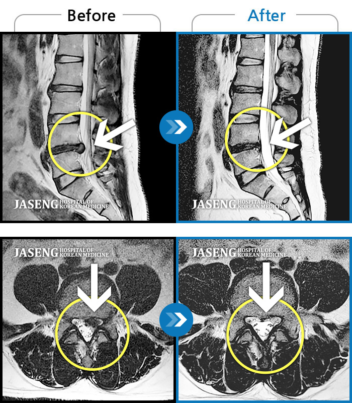 자생한방병원 치료사례 MRI로 보는 치료결과-허리와 좌측 다리 통증이 심하고 발목 힘이 빠져요. 