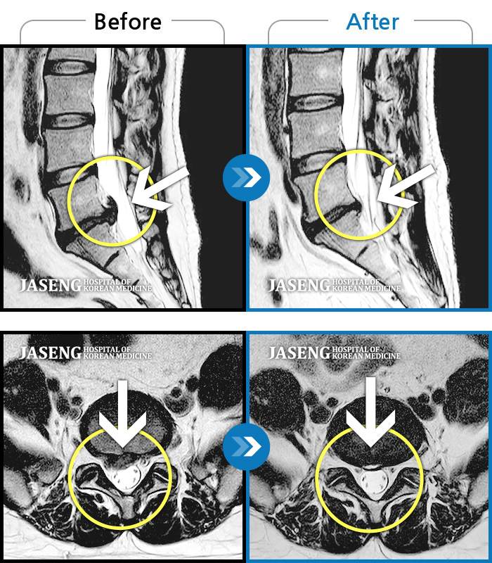 자생한방병원 치료사례 MRI로 보는 치료결과-허리와 양측 엉덩이가 아프고, 자세를 바꿀 때 통증이 더욱 심해진다.