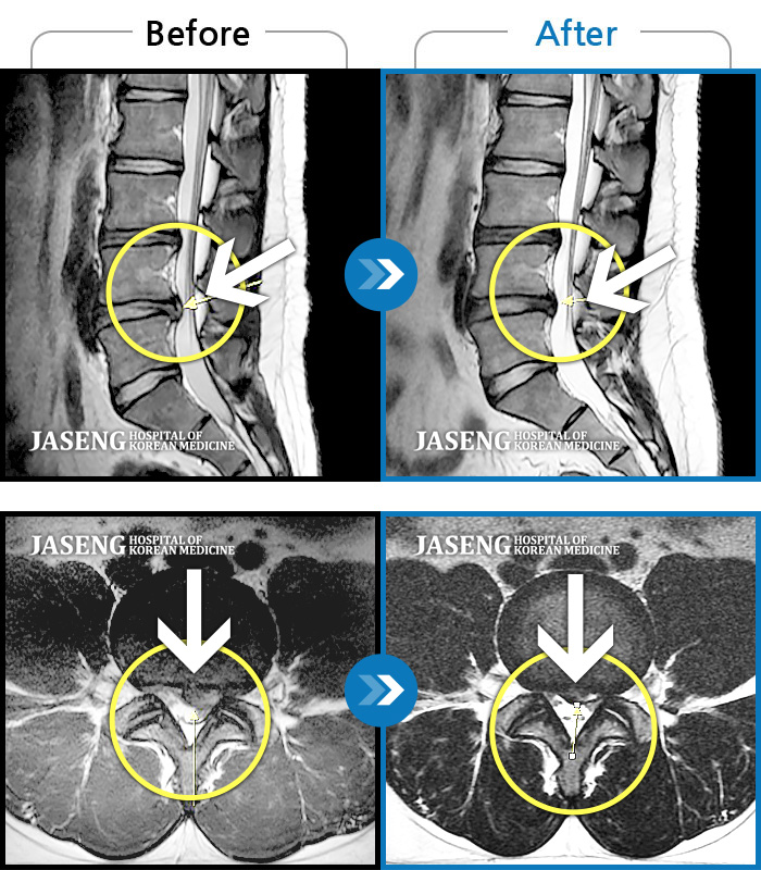 자생한방병원 치료사례 MRI로 보는 치료결과-좌측 하요추부 통증과 좌측 둔부에서부터 대퇴까지 후면 저림