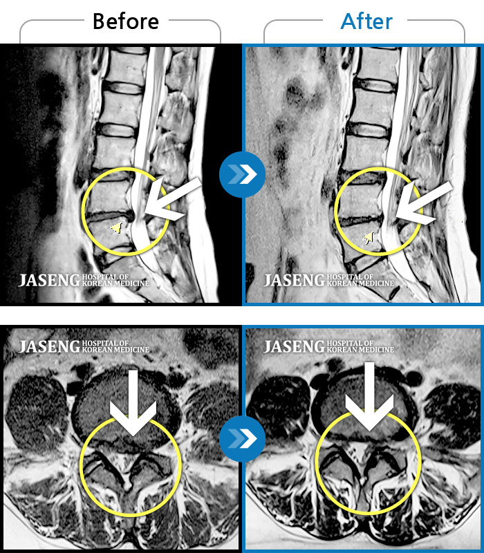 자생한방병원 치료사례 MRI로 보는 치료결과-양측 허리 통증, 좌측 하지 후면 통증 및 저림 증상