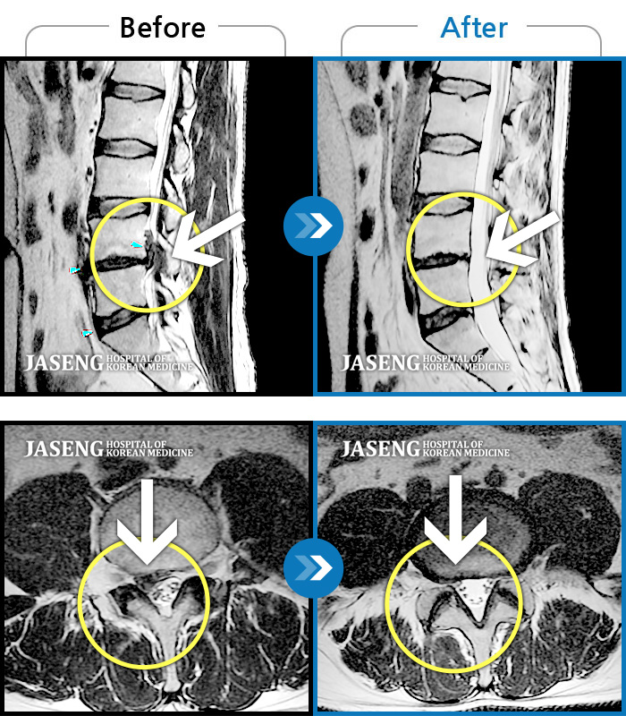 자생한방병원 치료사례 MRI로 보는 치료결과-우측 엉치 부터 발 끝까지 저리고 아픈 증상이 있었다. 