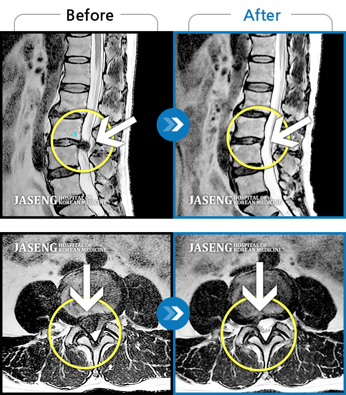 자생한방병원 치료사례 MRI로 보는 치료결과-우측 다리가 당겨서 걷기가 불편했다.