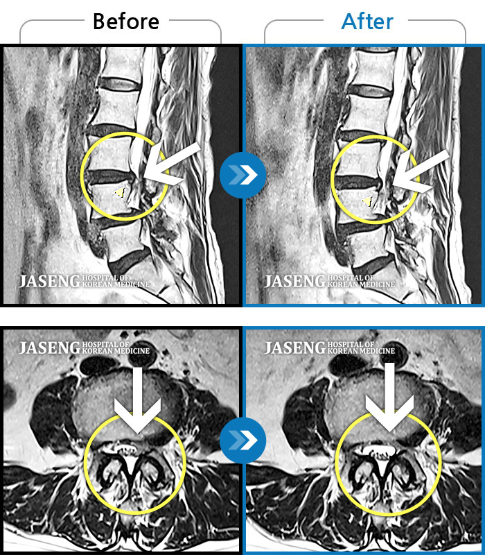 자생한방병원 치료사례 MRI로 보는 치료결과-허리 양측 골반 통증, 보행 시 다리에 힘이 잘 안 들어가 절뚝 거림