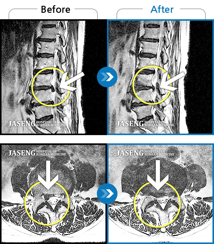 자생한방병원 치료사례 MRI로 보는 치료결과-오른쪽 허리, 골반이 많이 아팠고, 오른쪽 다리 저림이 심했다.