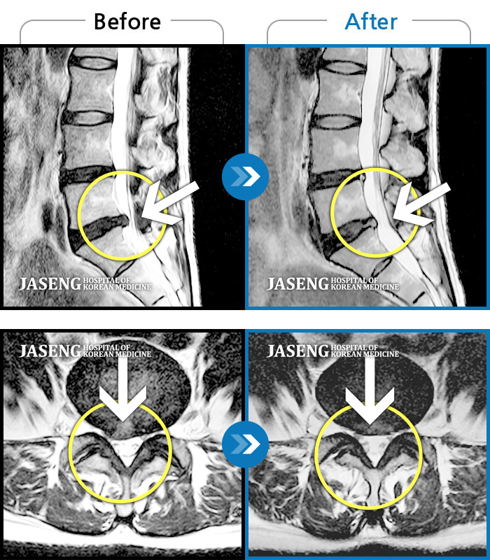 자생한방병원 치료사례 MRI로 보는 치료결과-다리가 하루 종일 저려 제대로 걷지 못했다.