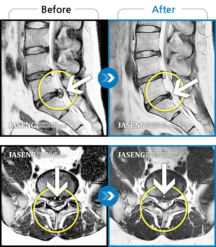 자생한방병원 치료사례 MRI로 보는 치료결과-허리 통증이 극심하여 혼자 움직일수가 없었다.
