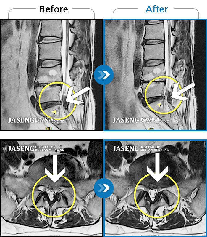 자생한방병원 치료사례 MRI로 보는 치료결과-추간판탈출증으로 양측 하지 후면 저림 증상