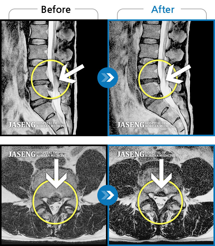 자생한방병원 치료사례 MRI로 보는 치료결과-허리와 우측 다리가 아파서 걸을 수도, 바로 누울수도 없어요