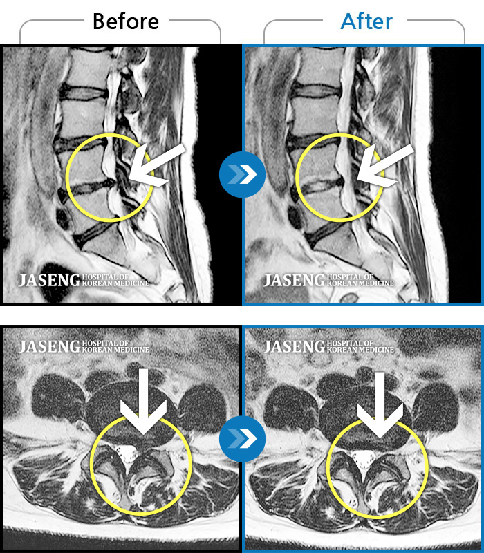 자생한방병원 치료사례 MRI로 보는 치료결과-반복적 업무 후 시작된 요통 왼쪽다리 방사통과 발가락의 감각저하로 내원