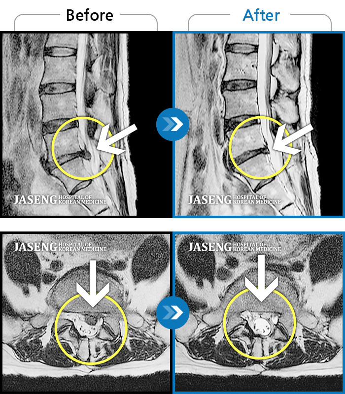 자생한방병원 치료사례 MRI로 보는 치료결과-서있으면 종아리가 터질 것 같이 아파요