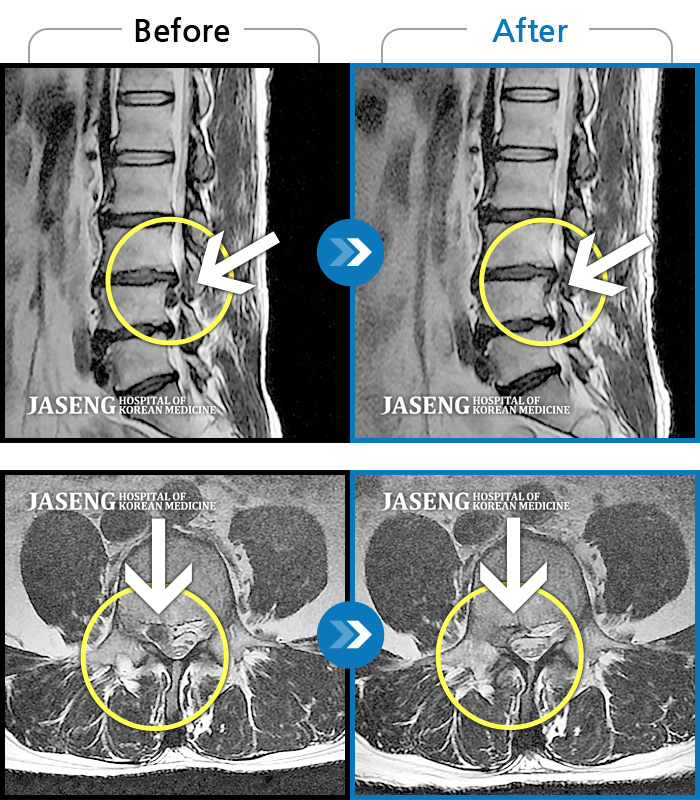 자생한방병원 치료사례 MRI로 보는 치료결과-허리통증 및 우측 다리 통증으로 거동이 어려운 상태, 야간에 잠을 못 잘 정도로 극심한 통증 호소