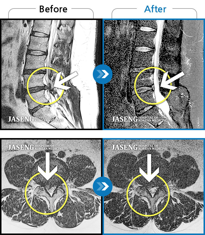 자생한방병원 치료사례 MRI로 보는 치료결과-허리 통증이 심해서 앉아 있을 수가 없어요.